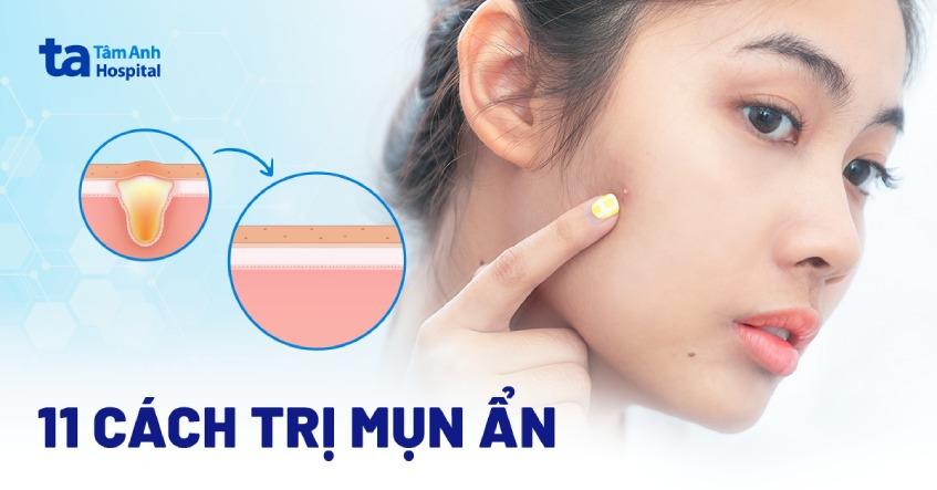 11 cách trị mụn ẩn dưới da hiệu quả được bác sĩ da liễu tin dùng