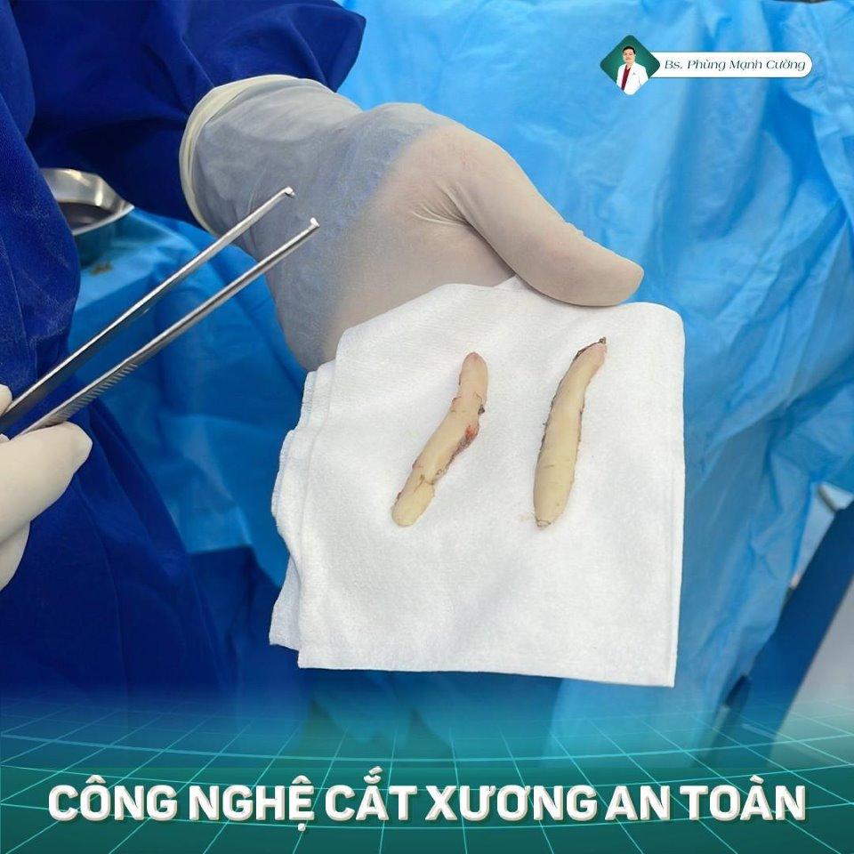 Phẫu Thuật Gọt Hàm Và Các Câu Hỏi Được BS Phùng Mạnh Cường Giải Đáp