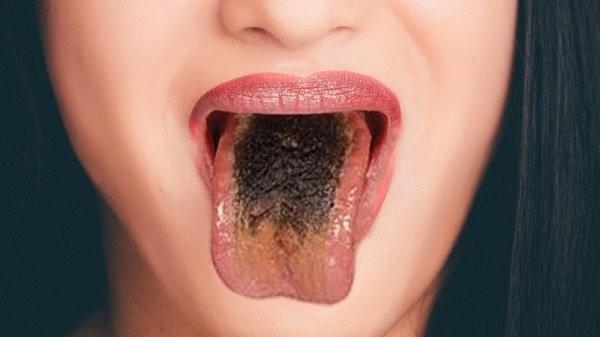 Lưỡi bị đen là gì? Nguyên nhân và cách điều trị