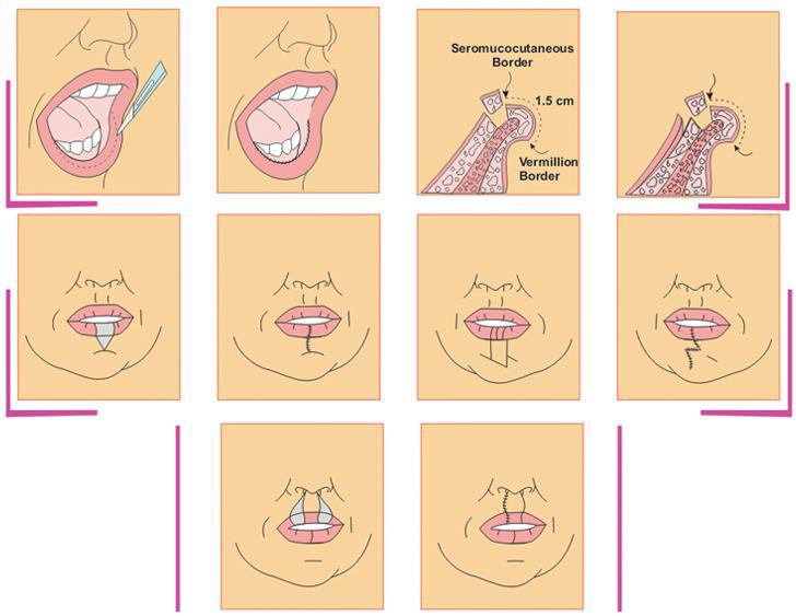 Tư vấn : Phẫu thuật môi dày thành mỏng giá bao nhiêu?