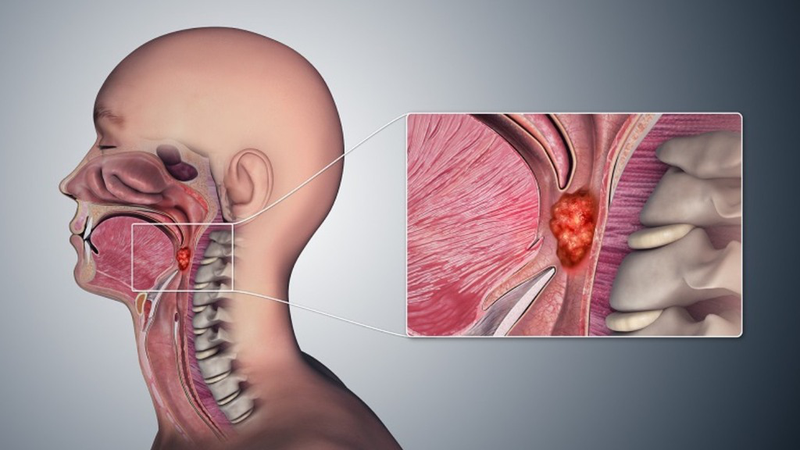 Ung thư vòm họng là gì? Gợi ý thực đơn cho người ung thư vòm họng