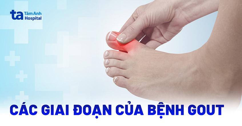 bệnh gout