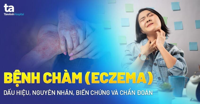 Biểu hiện đặc trưng của bệnh chàm tay chân là sự xuất hiện các nốt mụn nước gây ngứa.