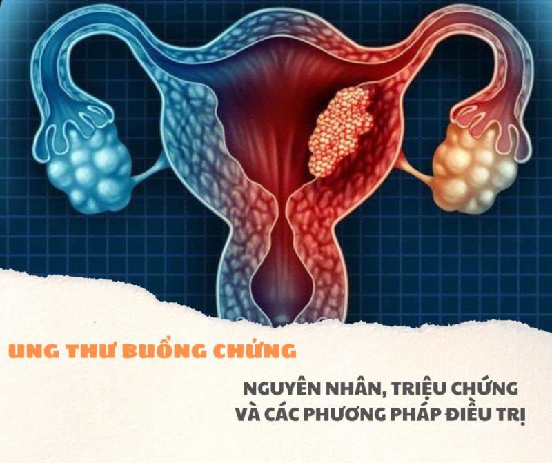 Ung thư buồng trứng: Nguyên nhân, triệu chứng và các phương pháp điều trị - Bệnh viện Bãi Cháy