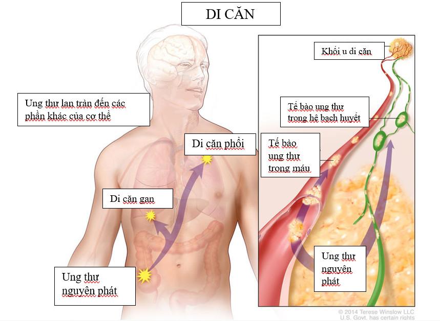 ung-thu-phoi-di-can