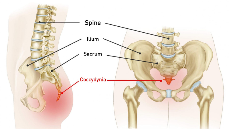 Chấn thương xương cụt: Nguyên nhân, triệu chứng, cách điều trị 1