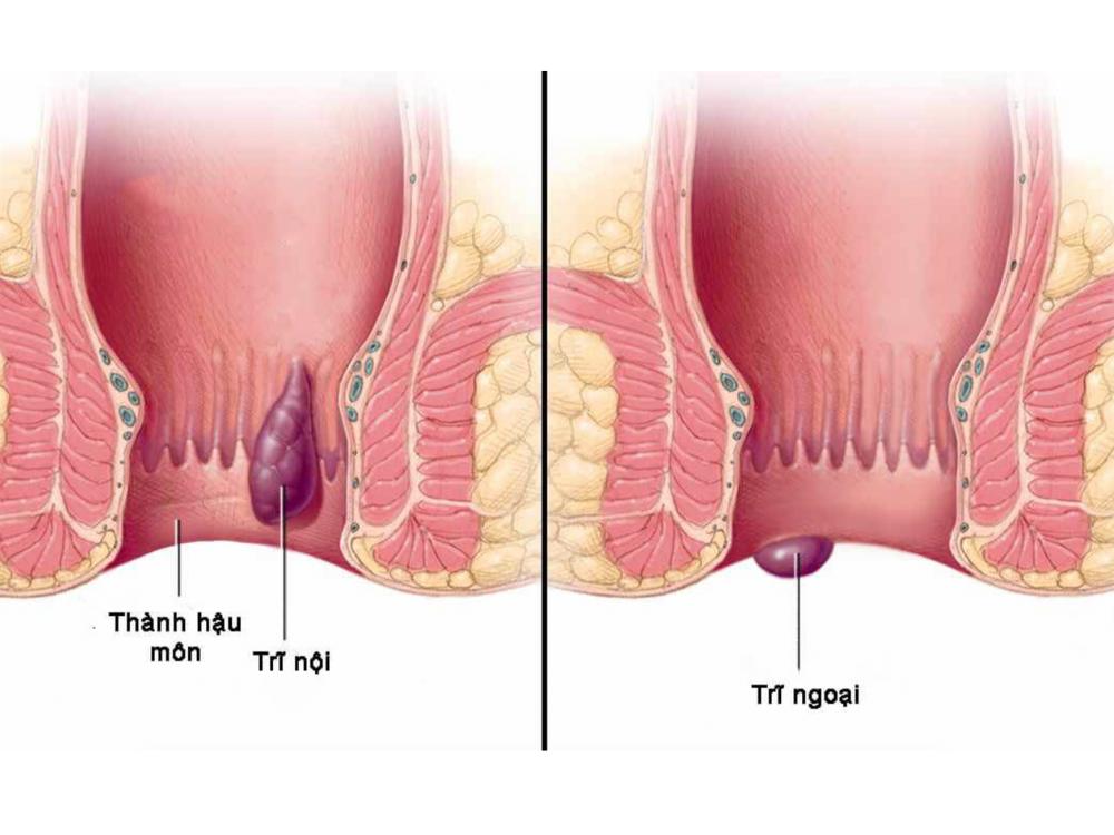 Bệnh trĩ